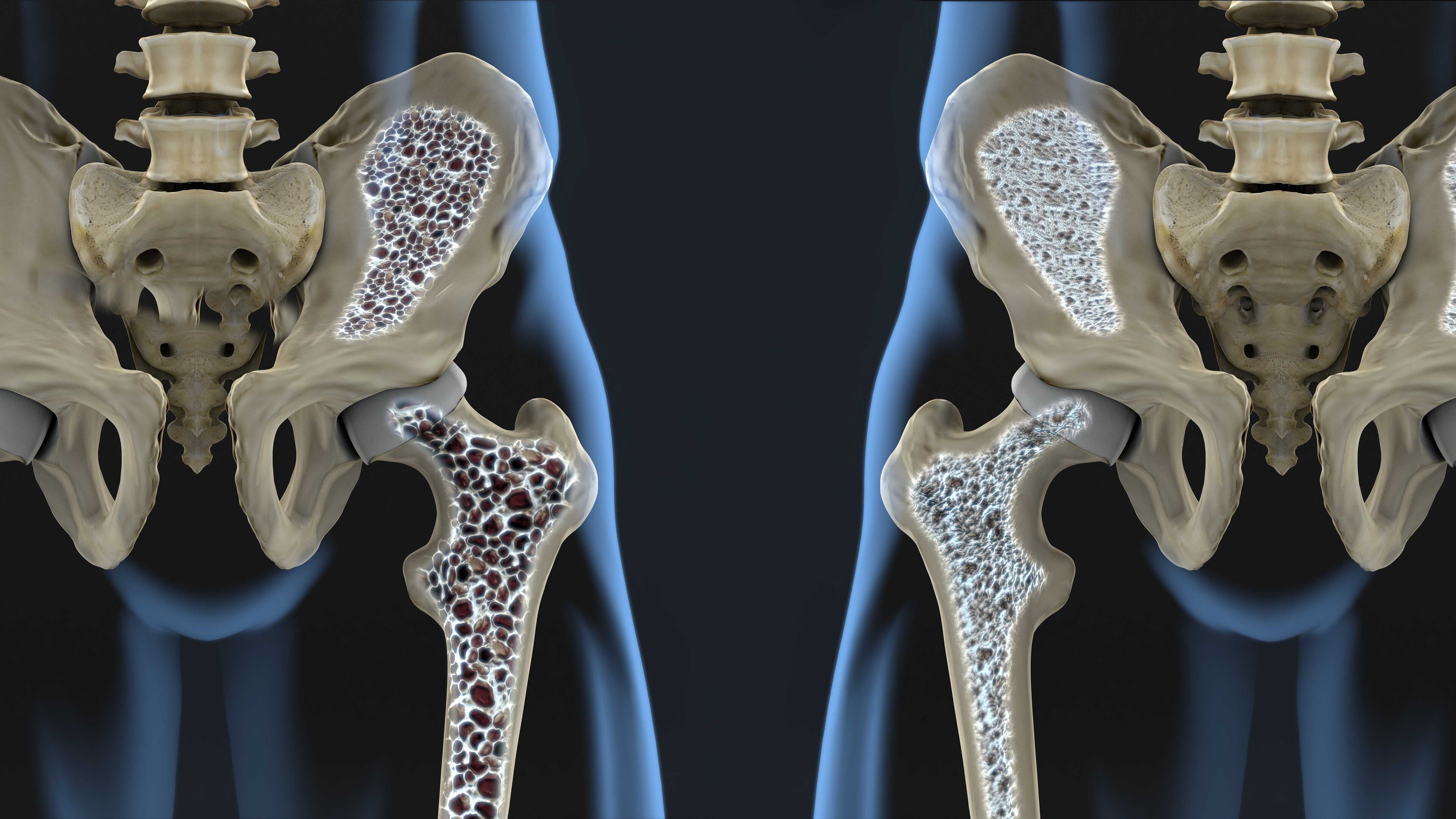 Osteoporose - Doenças Femininas - Gineco
