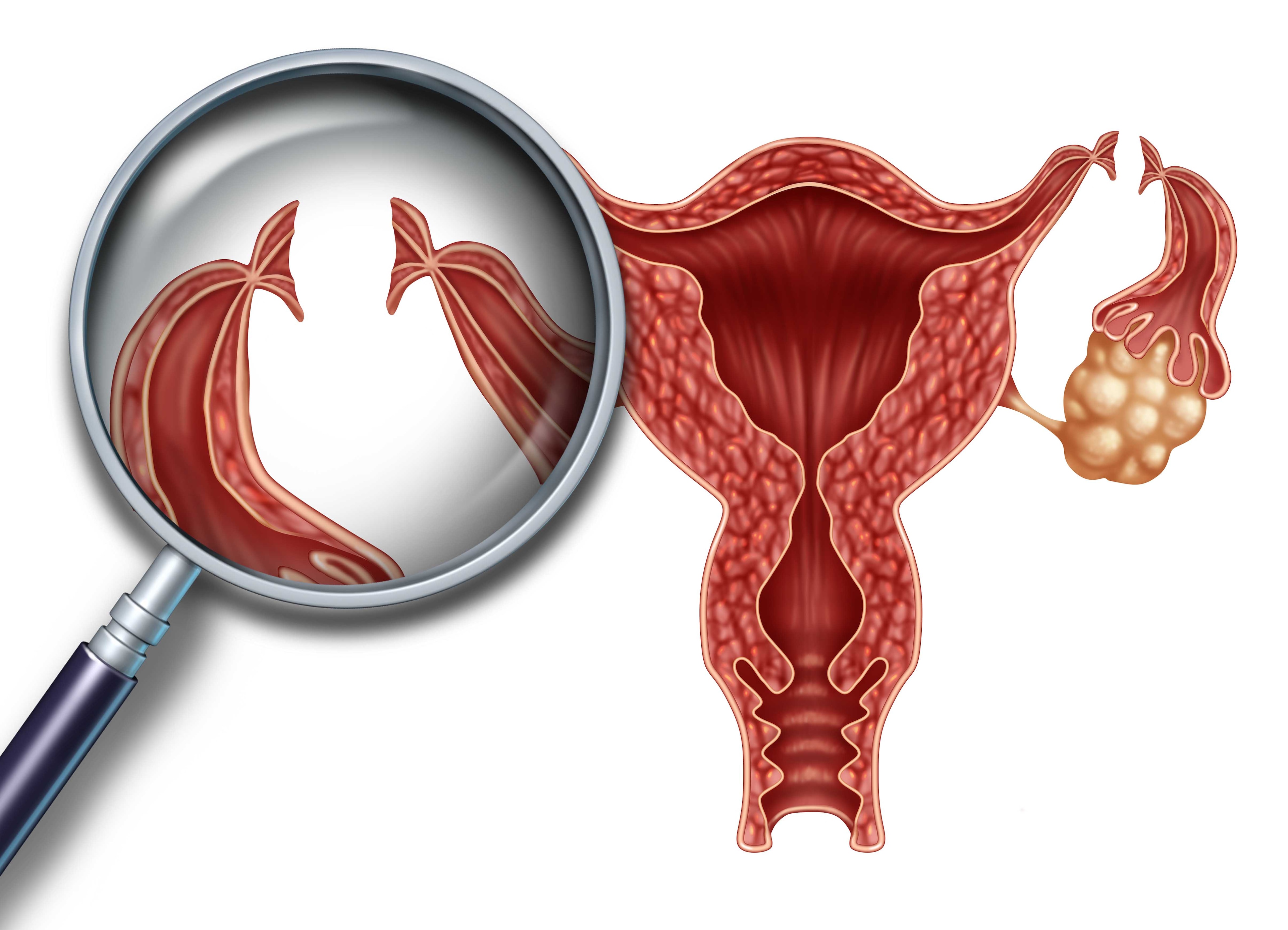 Ligadura De Trompas Metodos Contraceptivos Gineco