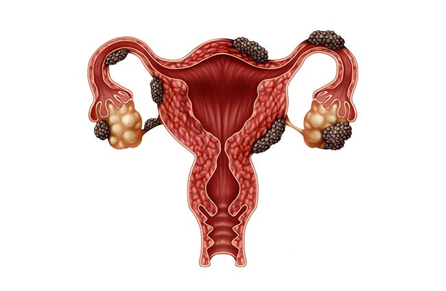 Especial Endometriose Especial Endometriose