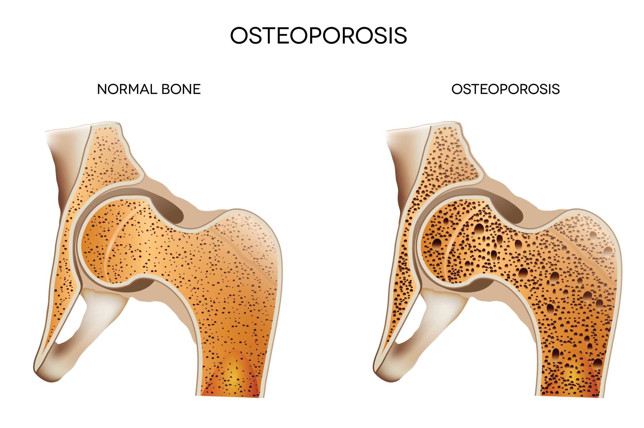 osteoporose