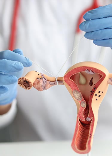 Esterilização Feminina