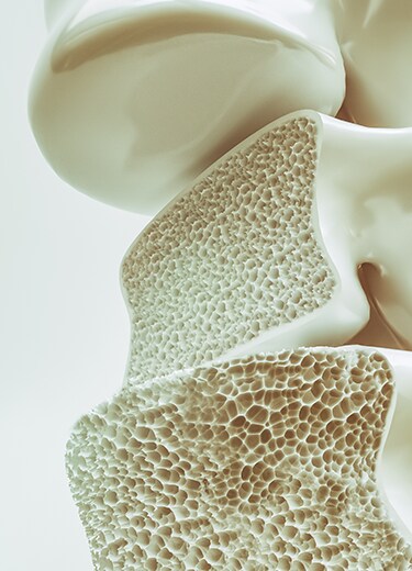 osteoporose
