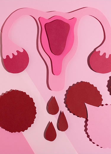Sangramento Uterino Anormal