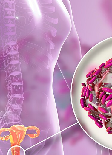 vaginose bacteriana